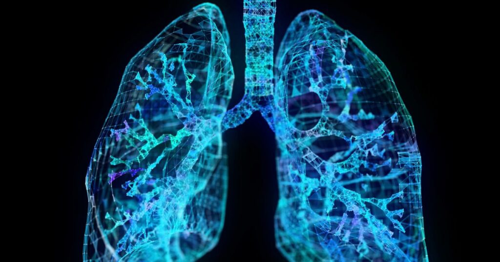 Asbestos lung cancer