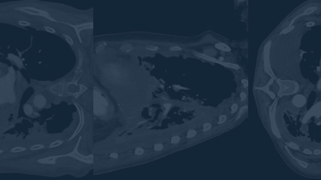 RPWB Case Type: Pleural Mesothelioma