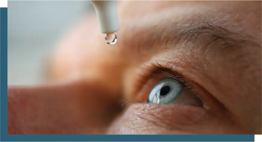 Close-up of eye with eye drop being applied for vision correction.