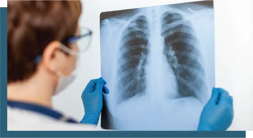 Healthcare worker reviewing a chest X-ray for lung assessment.