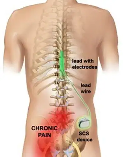 Diagram of spinal cord stimulator placement for chronic pain relief.