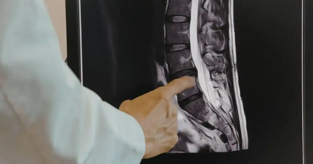 Doctor examining spinal MRI scan for medical assessment.